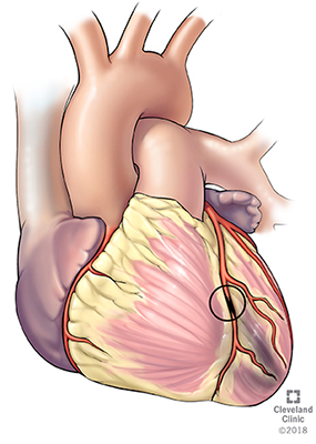 Coronary artery blockage causes ischemia