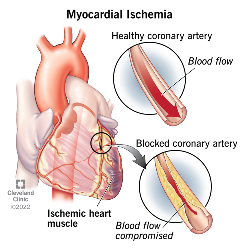 Comparison of a healthy coronary artery with a blocked one that leads to myocardial ischemia