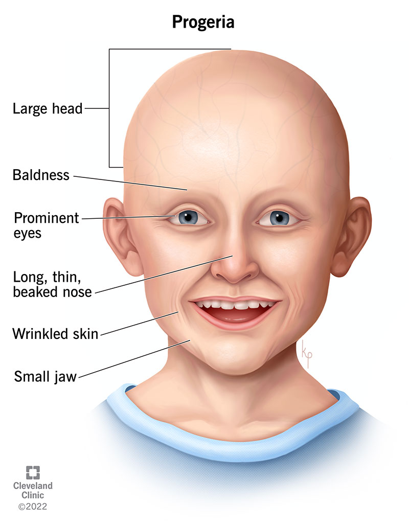 Starting within the first two years of life, children with progeria begin to show signs and symptoms of rapid aging.