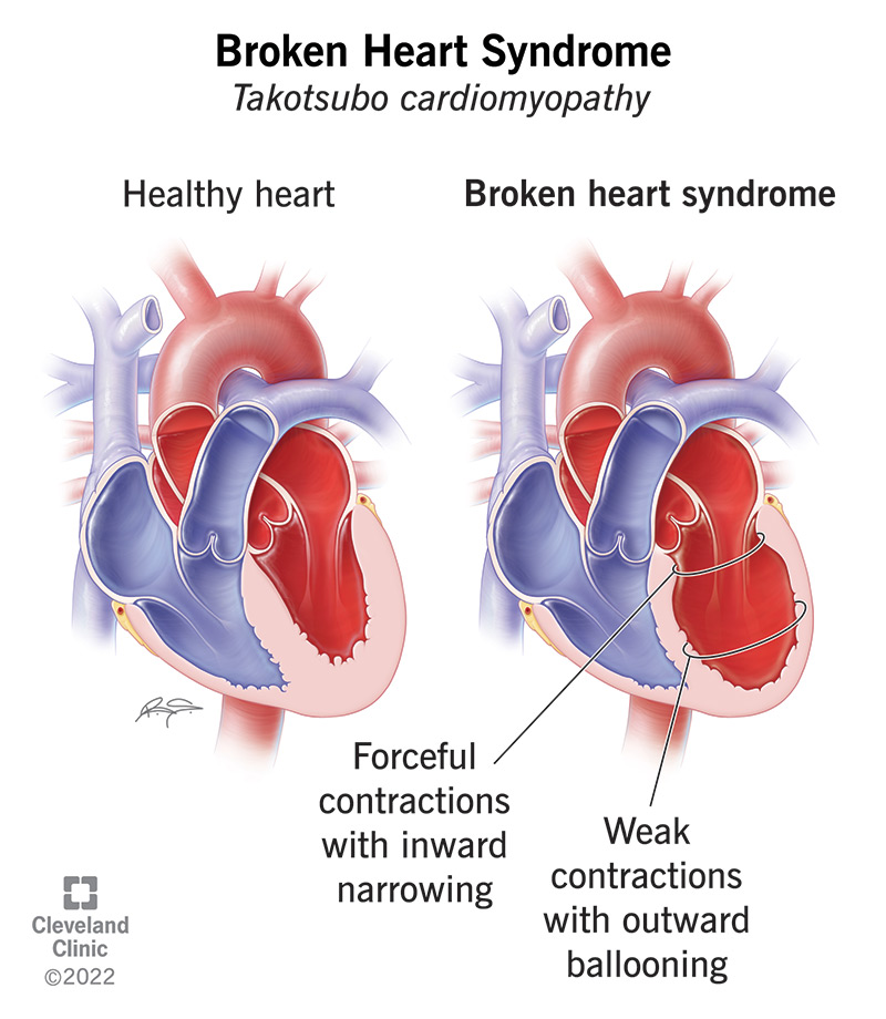 Differences between a healthy heart and one with broken heart syndrome.
