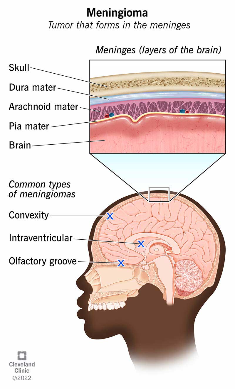 Common types of meningiomas include convexity, intraventricular and olfactory groove.