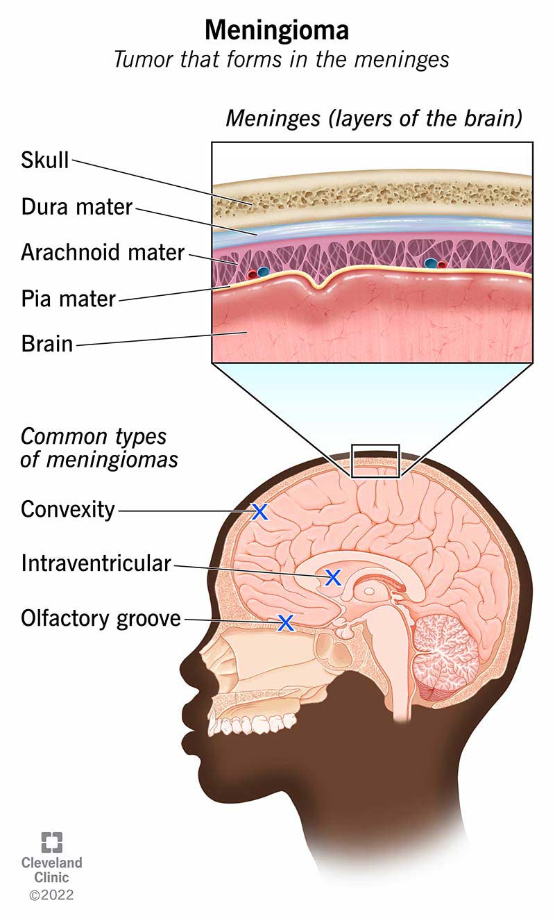 Meningioma: What It Is, Causes, Symptoms & Treatment