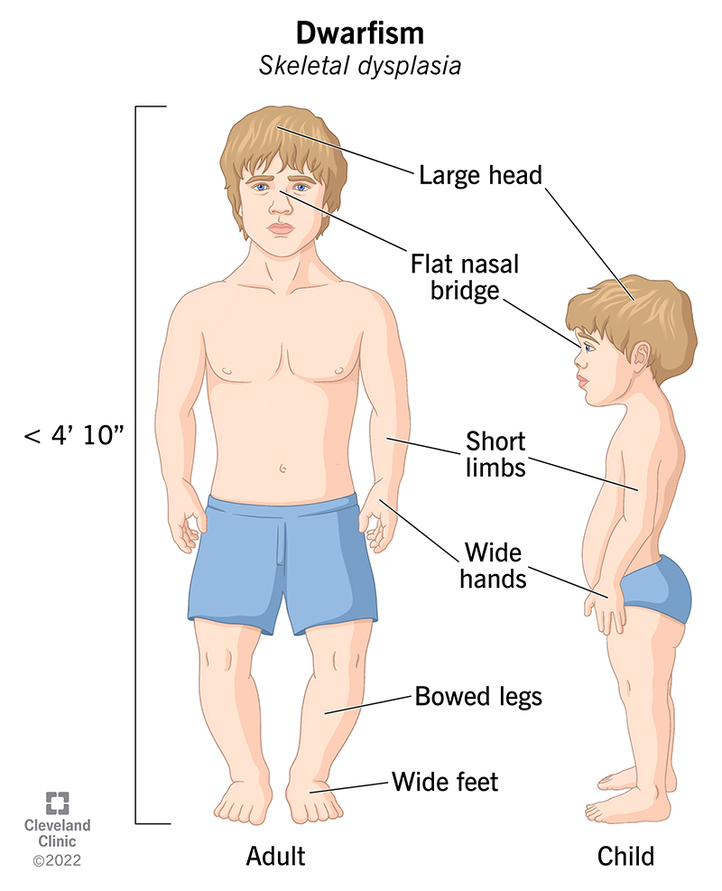 A child with dwarfism (skeletal dysplasia) has unique features that affect their skeleton. These features continue into adulthood.