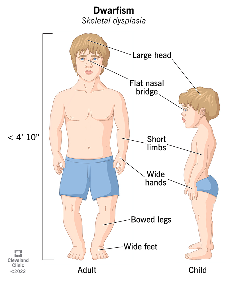 achondroplastic dwarfism