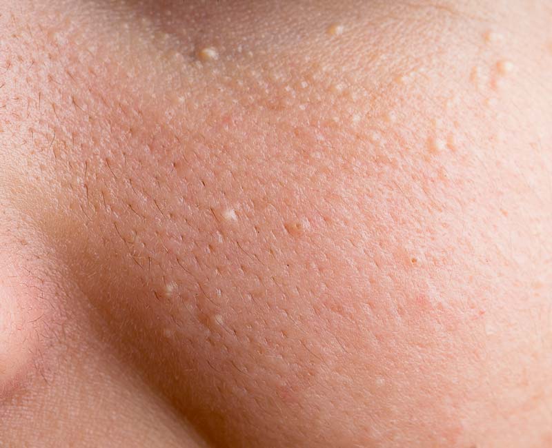 Milia, or milk spots, on a person’s skin.