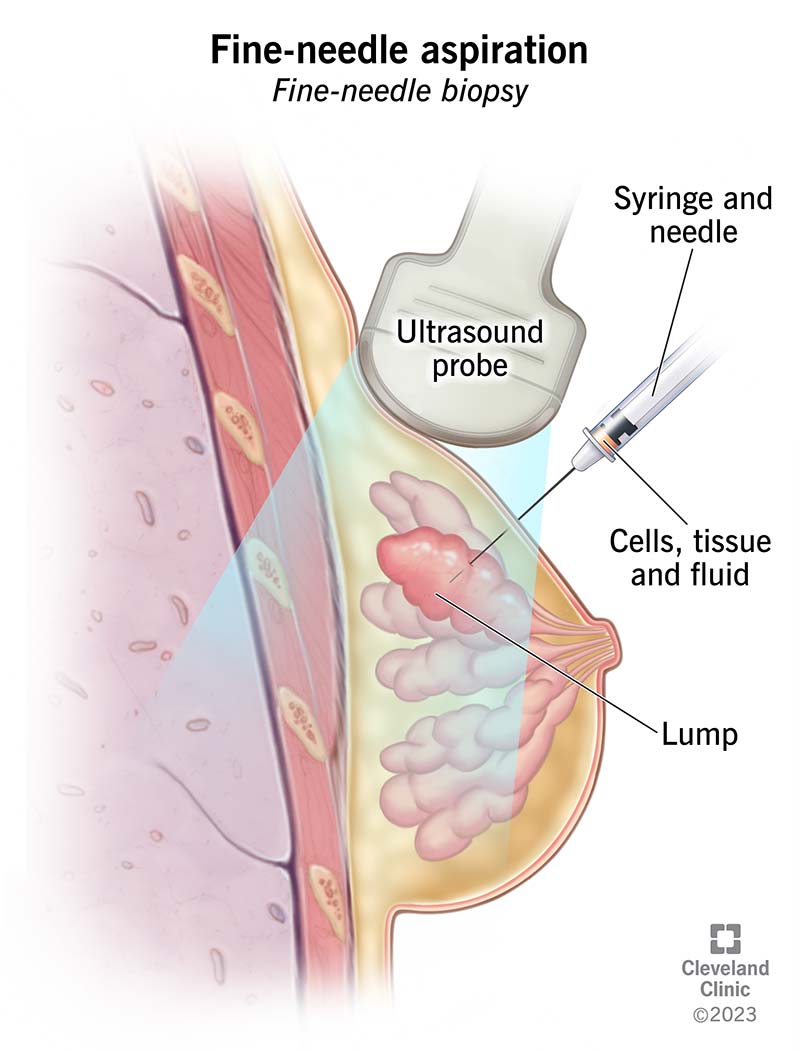 Illustration showing a needle and syringe drawing fluid from a lump in breast tissue. It also shows an ultrasound probe.