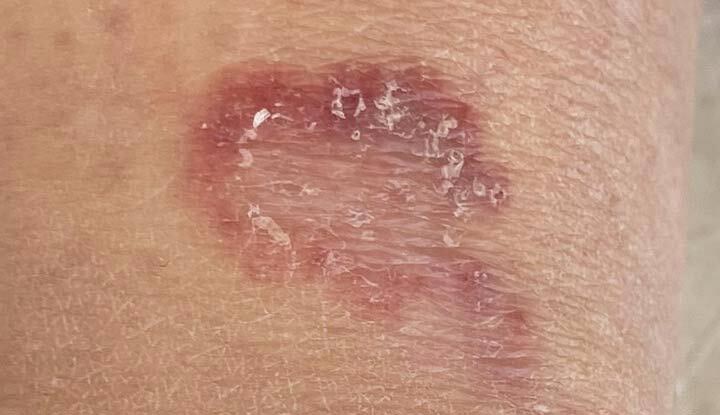 Raised, discolored rash associated with granuloma annulare.