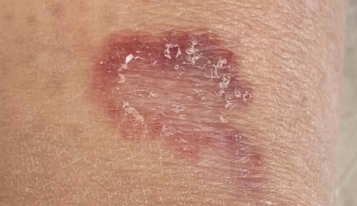 Red Spots on Skin: Causes, Treatment, Prevention Tips (2024)