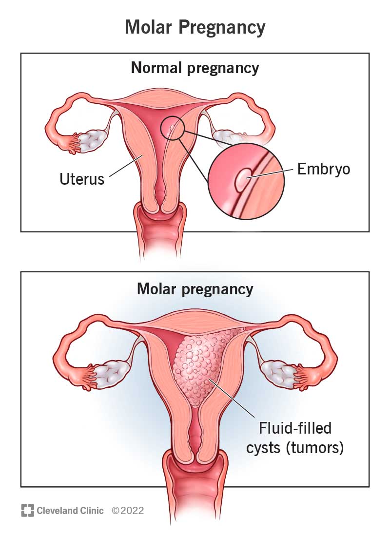 A molar pregnancy showing a uterus filled with small, fluid-filled sacs (tumors) instead of a placenta.