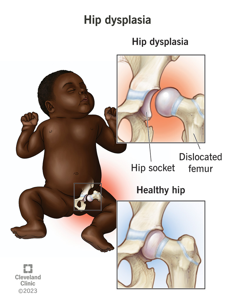 Baby with a hip dislocation.