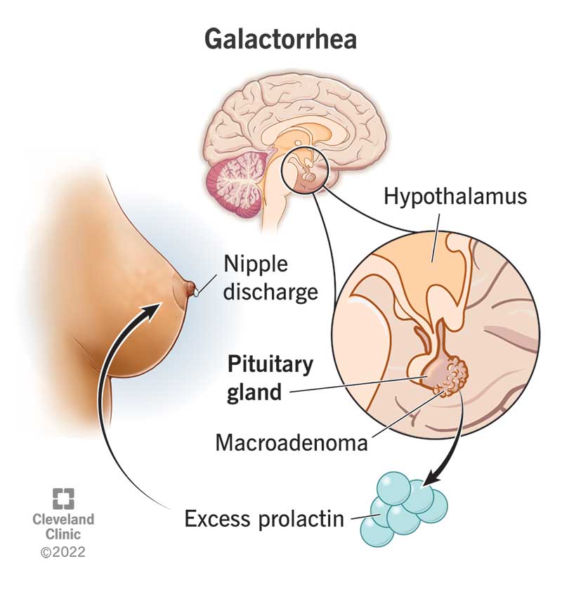 Galactorrhea Causes Symptoms Treatment