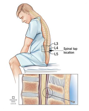 Area of lower spine where spinal tap is taken and close-up of needle in the spinal canal.