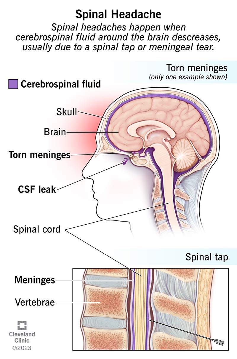Spinal headaches happen when cerebrospinal fluid around your brain decreases, usually due to a spinal tap or meningeal tear.