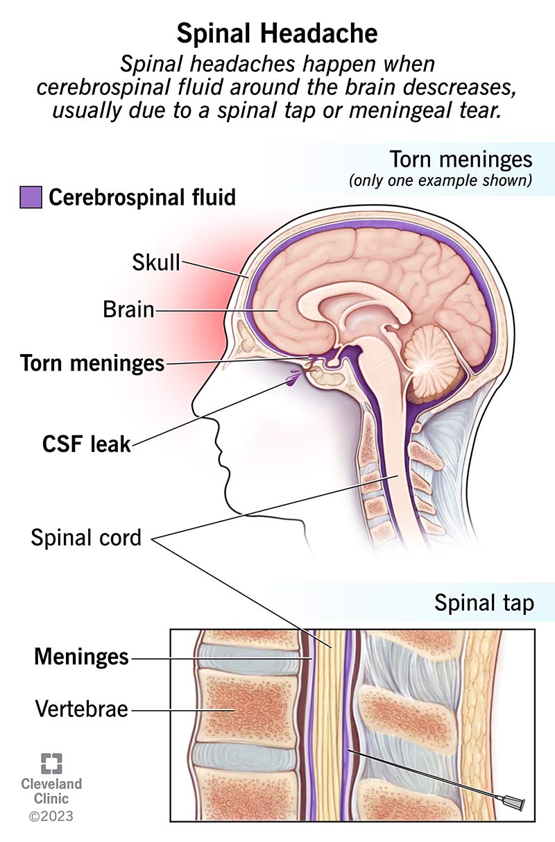 Spinal Headache: What It Is, Causes, Symptoms & Treatment