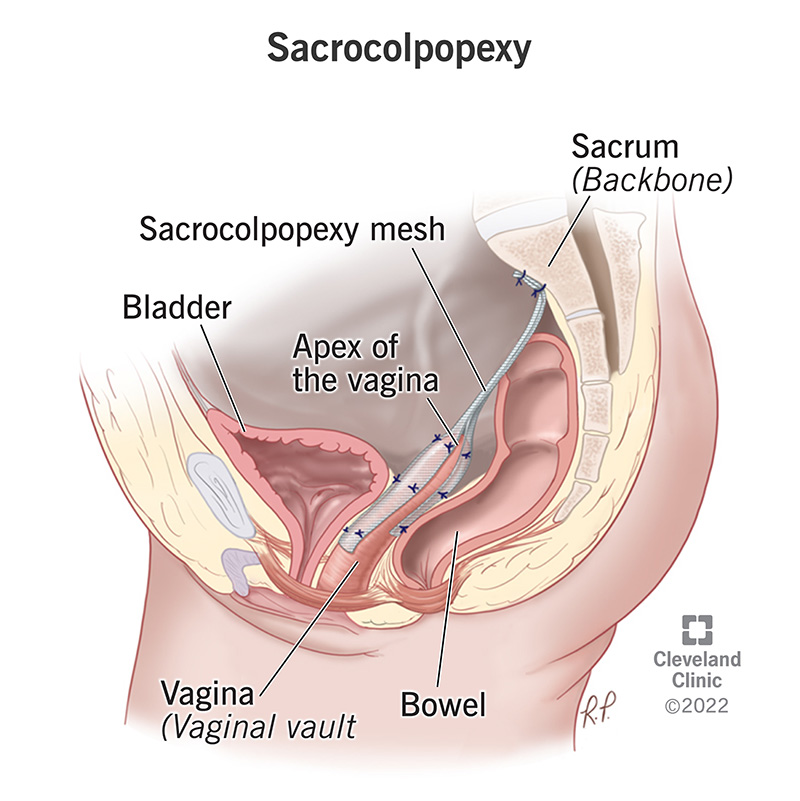 Prolapsed Bladder (Cystocele) Surgical Repair with a Vaginal Slin