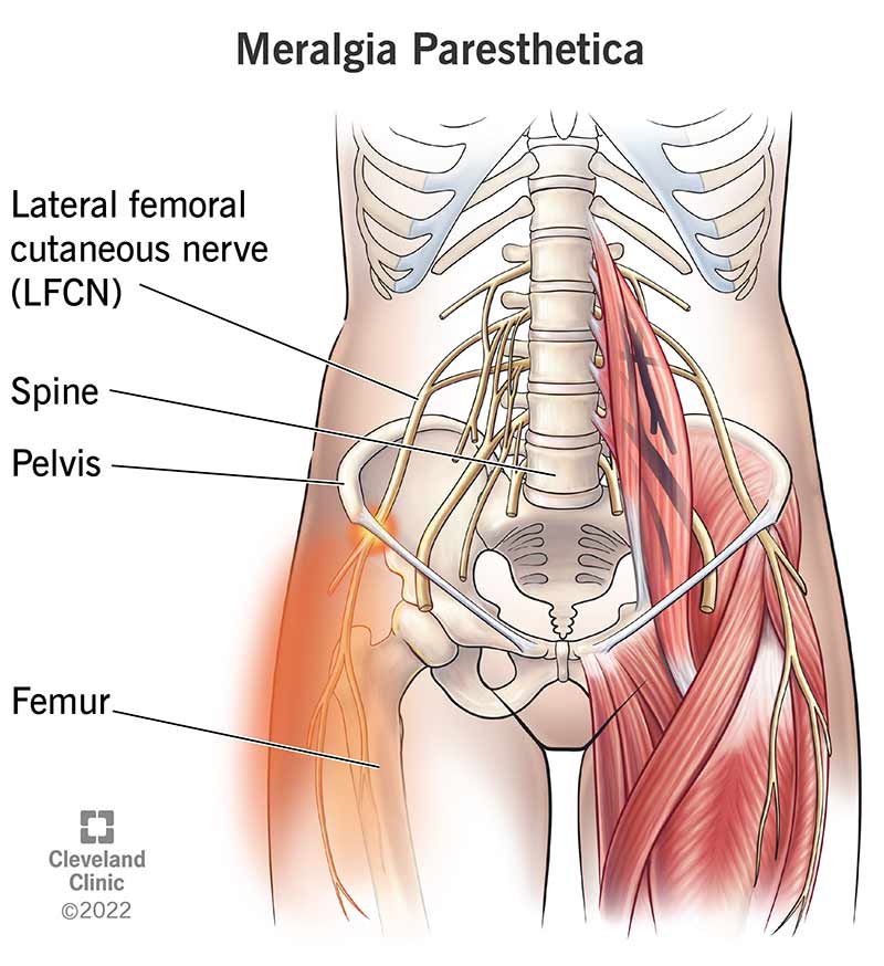 Inflammation of the lateral femoral cutaneous nerve, which starts in your spine and extends down your pelvis and thigh.