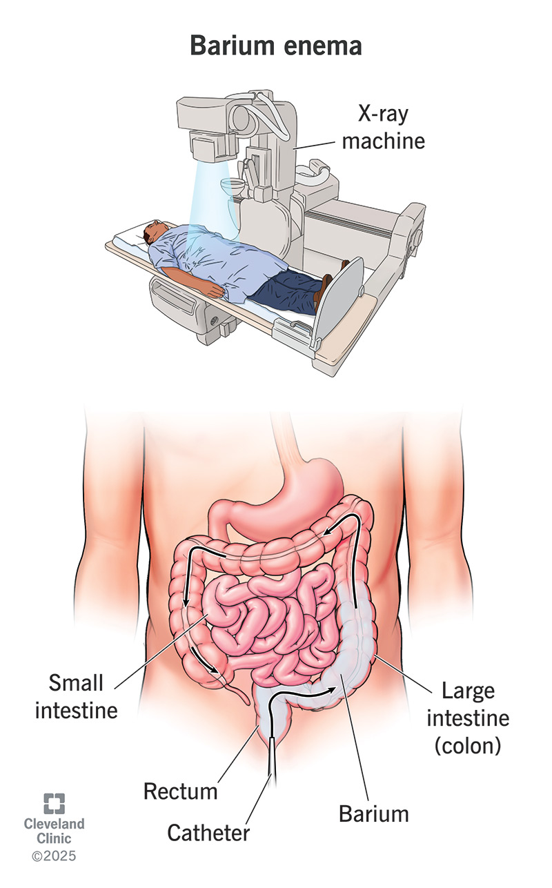 A person lying down as an X-ray machine takes images through their abdomen. The images show barium in the large intestine.