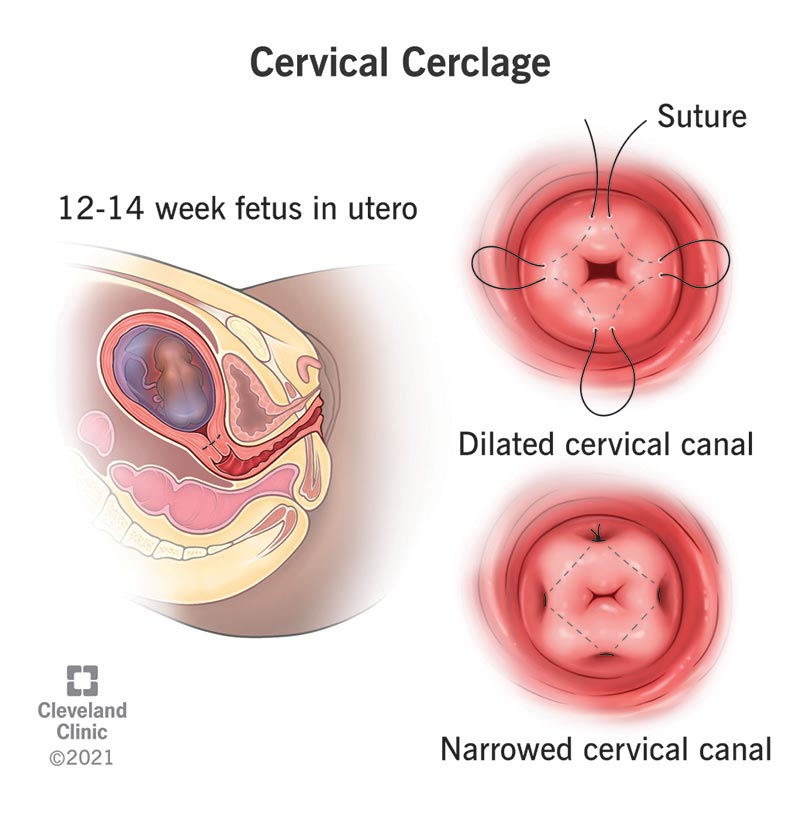 Cervical opening with and without cervical cerclage.