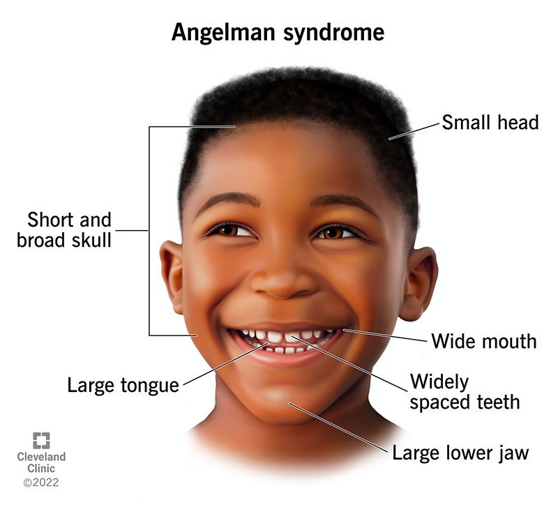 Angelman syndrome can cause some distinct facial characteristics, including a short and broad skull, widely spaced teeth and an abnormally large tongue.