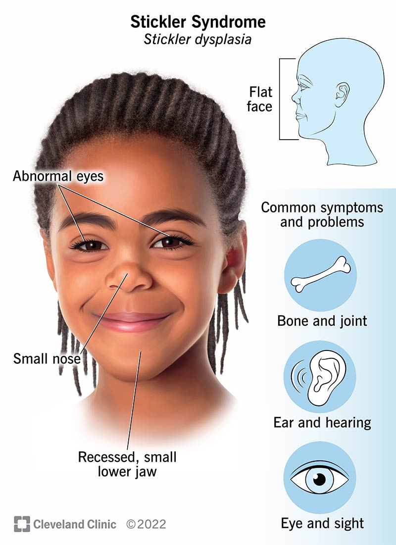 An illustration of symptoms that affect a child diagnosed with Stickler syndrome.