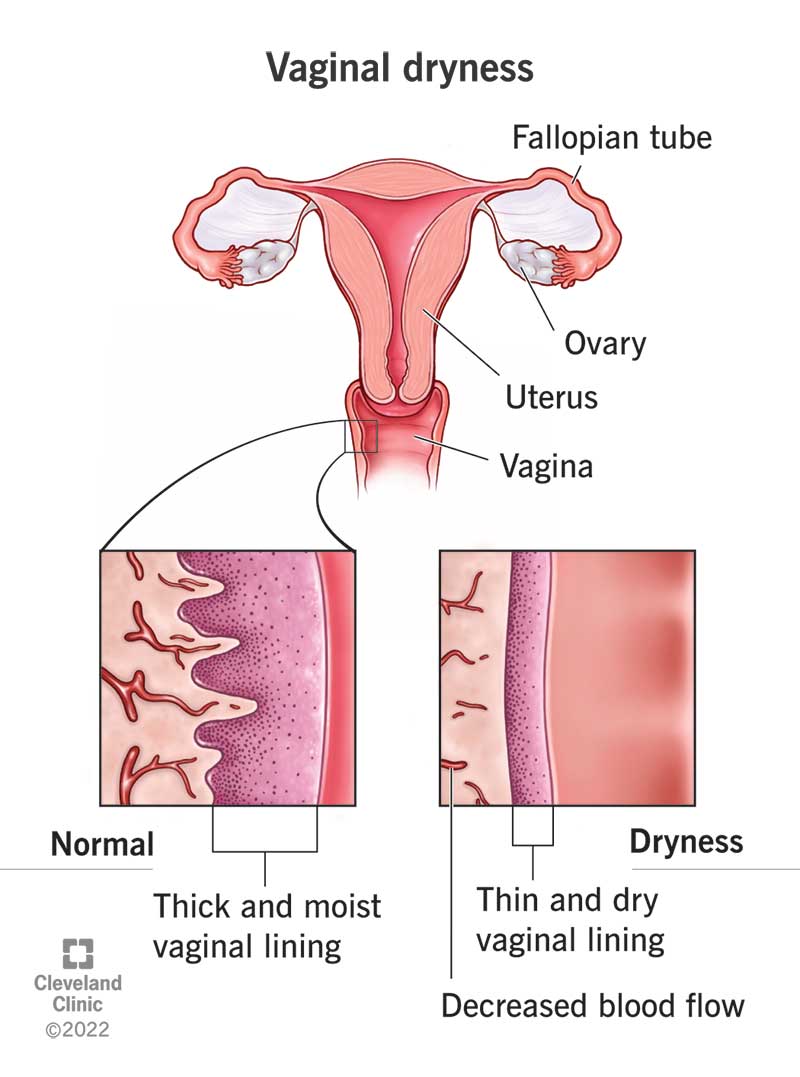 A dry, thin vaginal lining compared to a normal, moist vaginal lining.