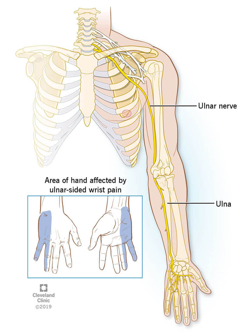 Position of ulnar nerve in a human runs from the neck, down arm, to pinkie finger. Inset picture shows front and back side of hand affected by ulnar-sided wrist pain.