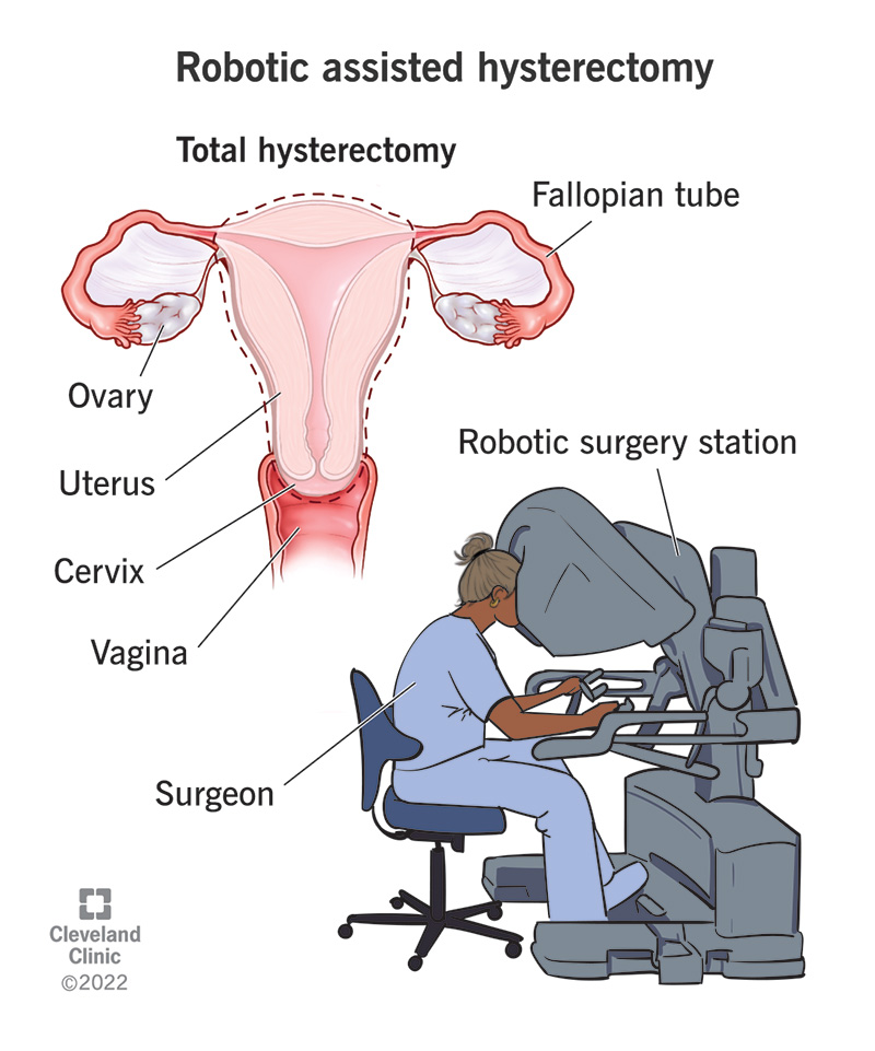 A surgeon sitting at a robotic surgery station next to a diagram of the female reproductive system with the uterus and cervix removed.