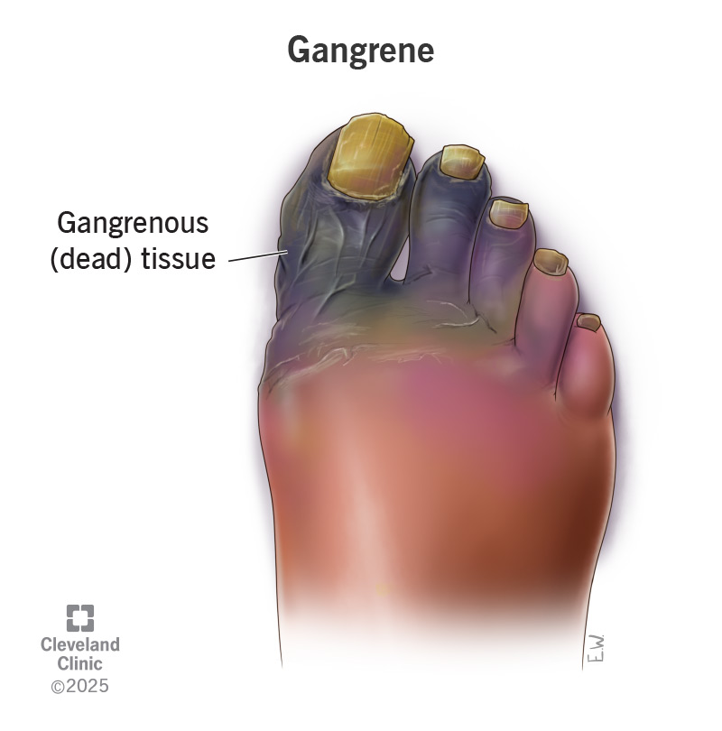 If you have gangrene, the affected skin may look purple, green or black in color