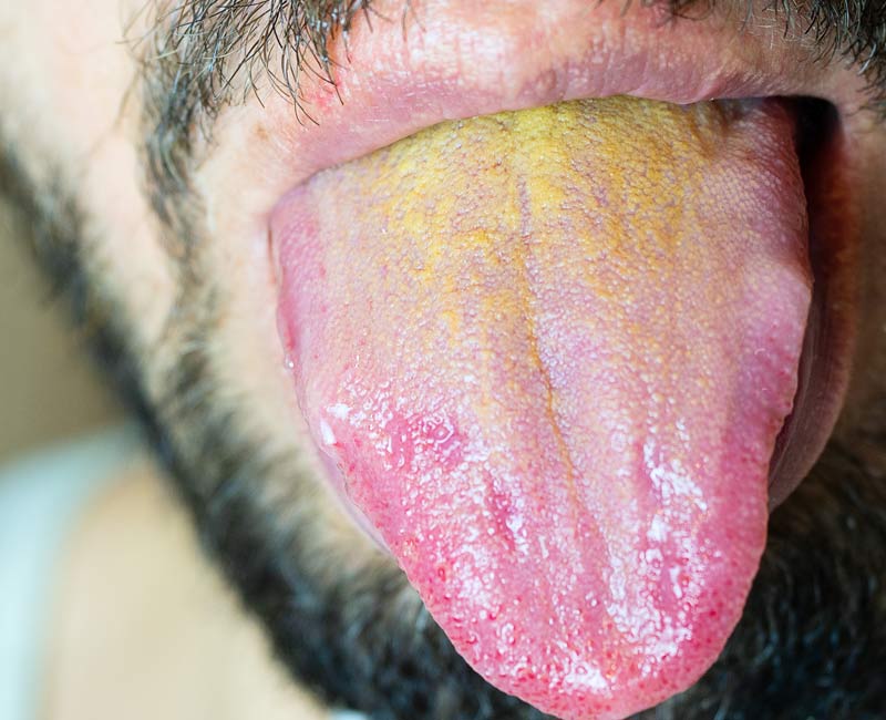 Person sticking out their yellow tongue