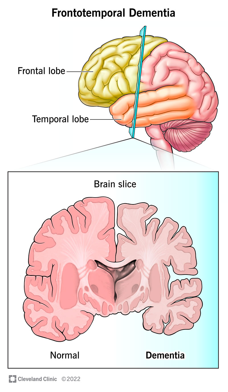 Brain tissue deteriorates in the frontal (front) and temporal (sides) lobes of your brain when you have frontotemporal dementia.