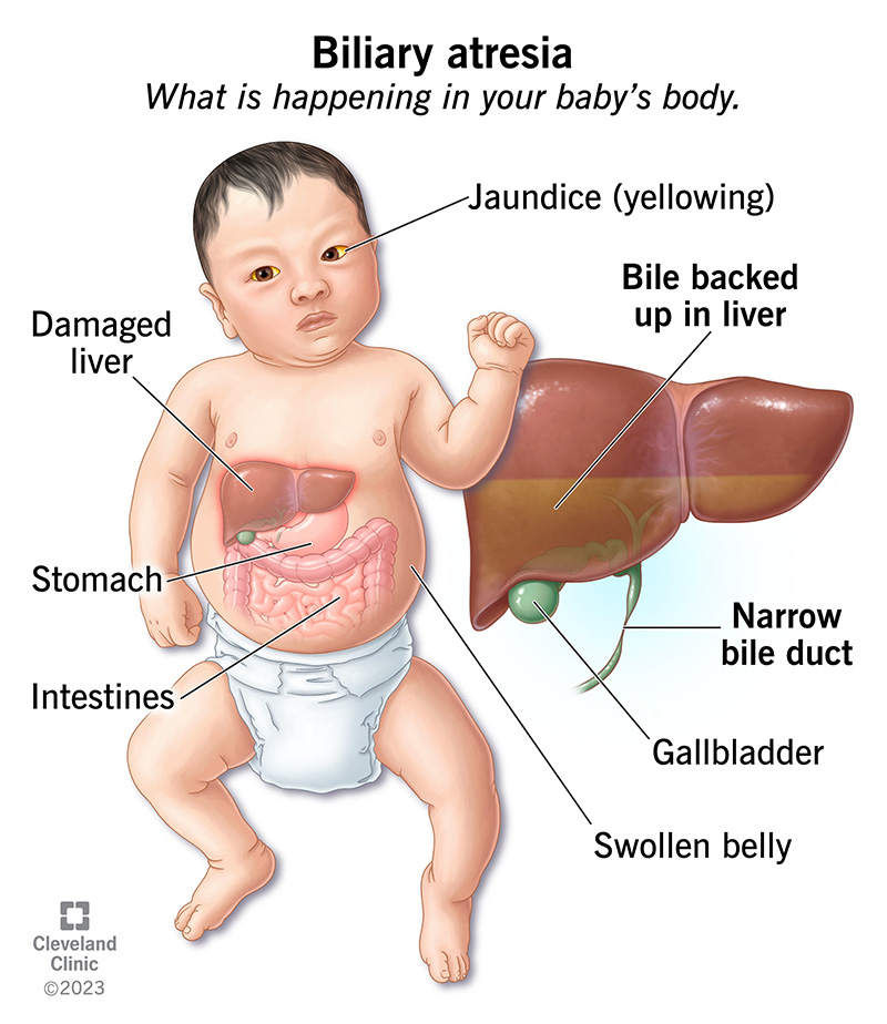 Biliary atresia leads to stalled bile flow in a baby’s liver and related symptoms like jaundice and a swollen belly.