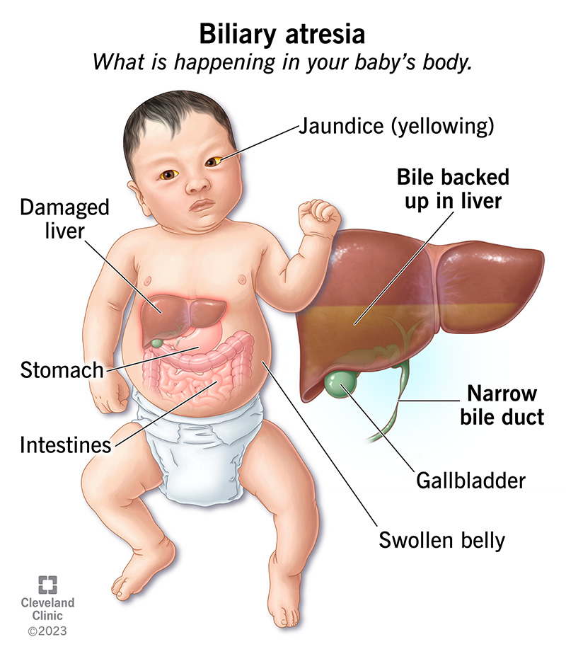 Biliary Atresia Symptoms & Causes