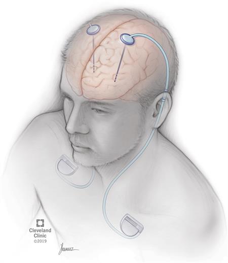 Deep Brain Stimulation (DBS): What It Is, Purpose & Procedure