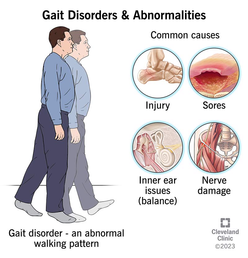 A person walking with a gait disorder or an abnormal walking pattern. The illustration shows four possible causes.