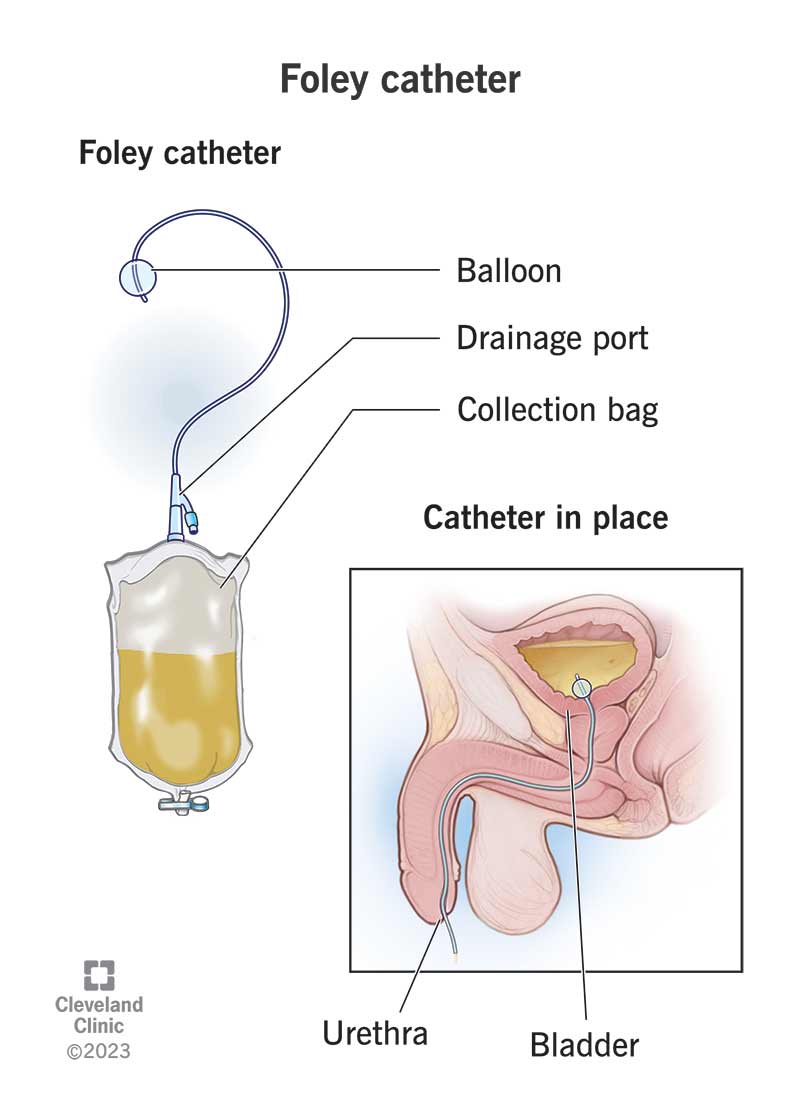 A Foley catheter includes a tube, drainage port and bag. A balloon keeps it in place. Pee goes through the tube into the bag.