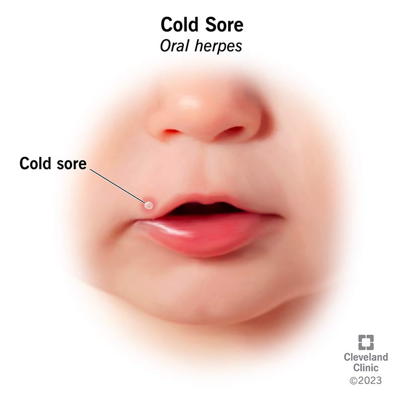 A cold sore (oral herpes), a fluid-filled blister, around a mouth