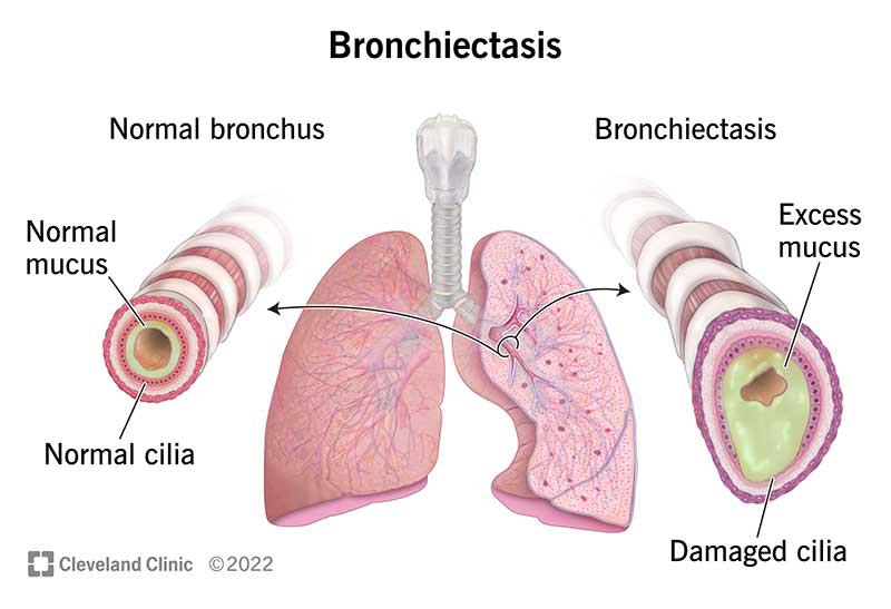Comparison of normal lung versus bronchiectasis. Bronchiectasis shows excess mucus, damaged cilia and widening of airway.