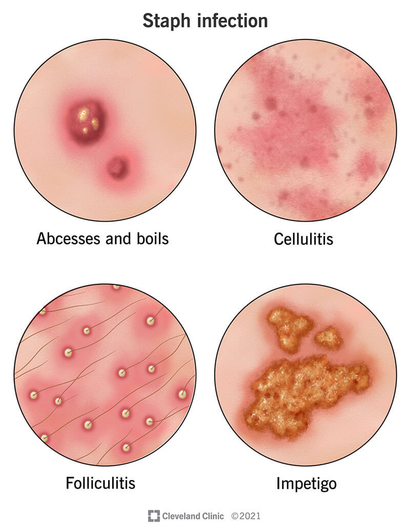 A staph infection on the skin can present as small pus-filled lumps with folliculitis, larger lumps with abscesses and boils and irregular scabs with impetigo, while cellulitis within the skin shows as inflamed patches.