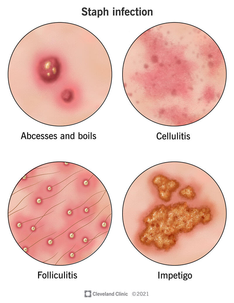 Staph Infection: Symptoms, Diagnosis, Treatment, and More