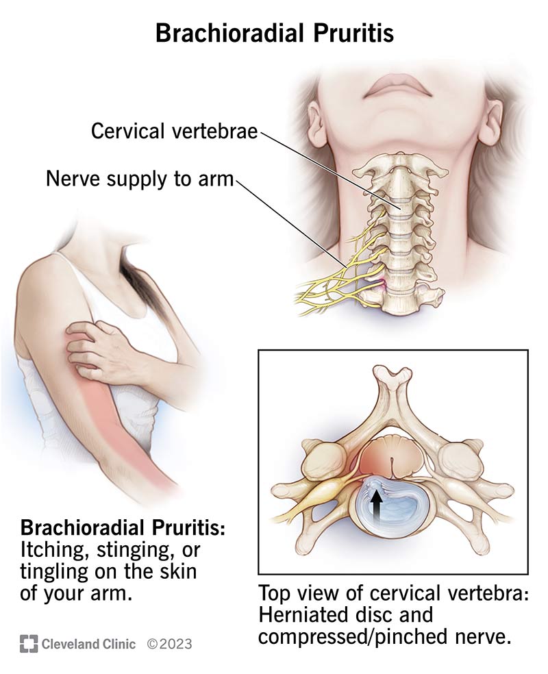 Illustration showing pinched nerve root in cervical (neck) vertebra.