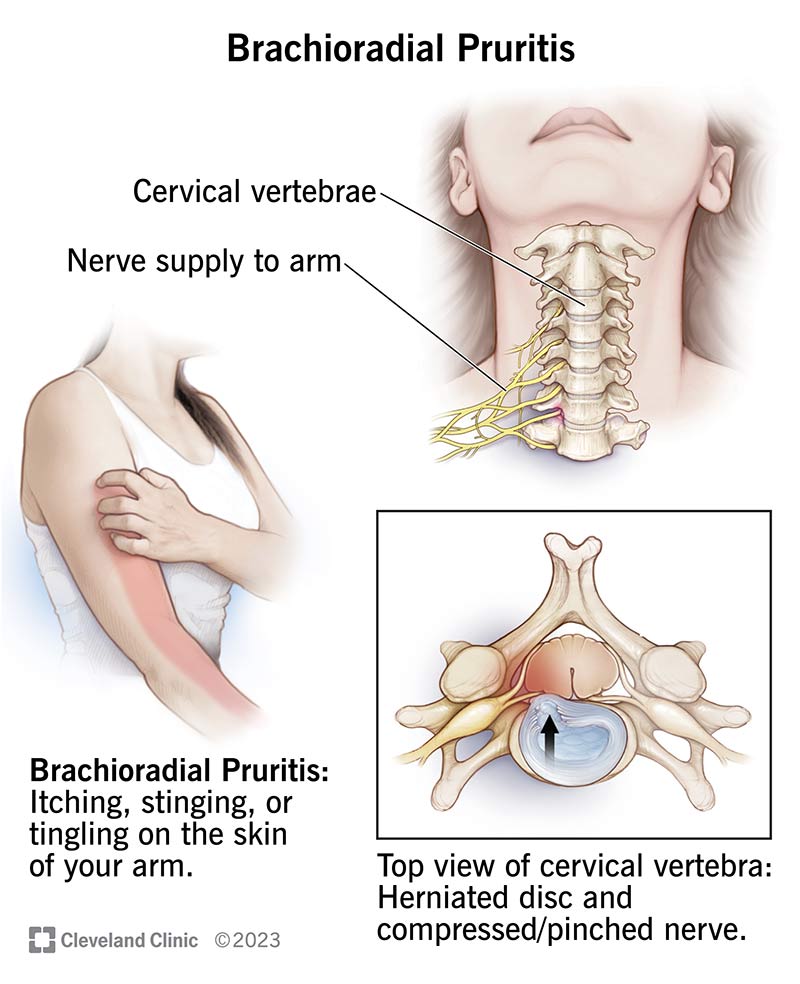 Itchy Back or Arms