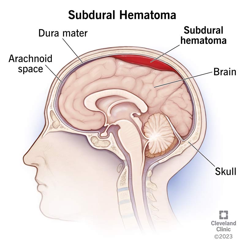 Subdural hematoma, with pool of blood near the brain under the dura mater, inside skull