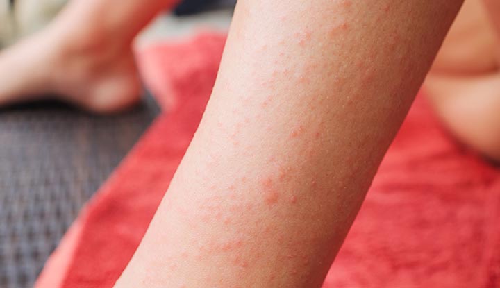 Dermatitis herpetiformis bumps on a person’s skin.