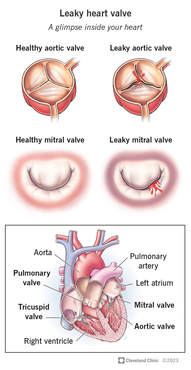 A set of illustrations showing the difference between a healthy heart valve and a leaky heart valve. A diagram shows the location of each of your four heart valves.