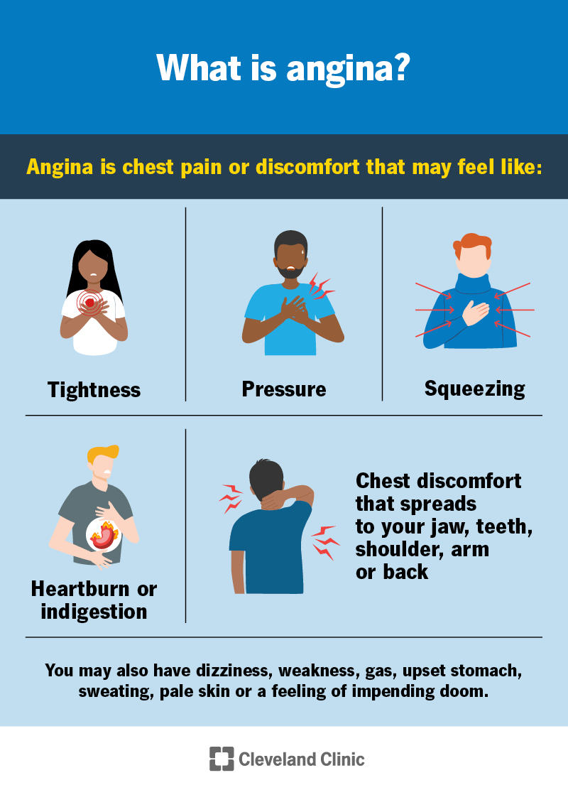 Angina may feel like pain, pressure, tightness or squeezing in your chest