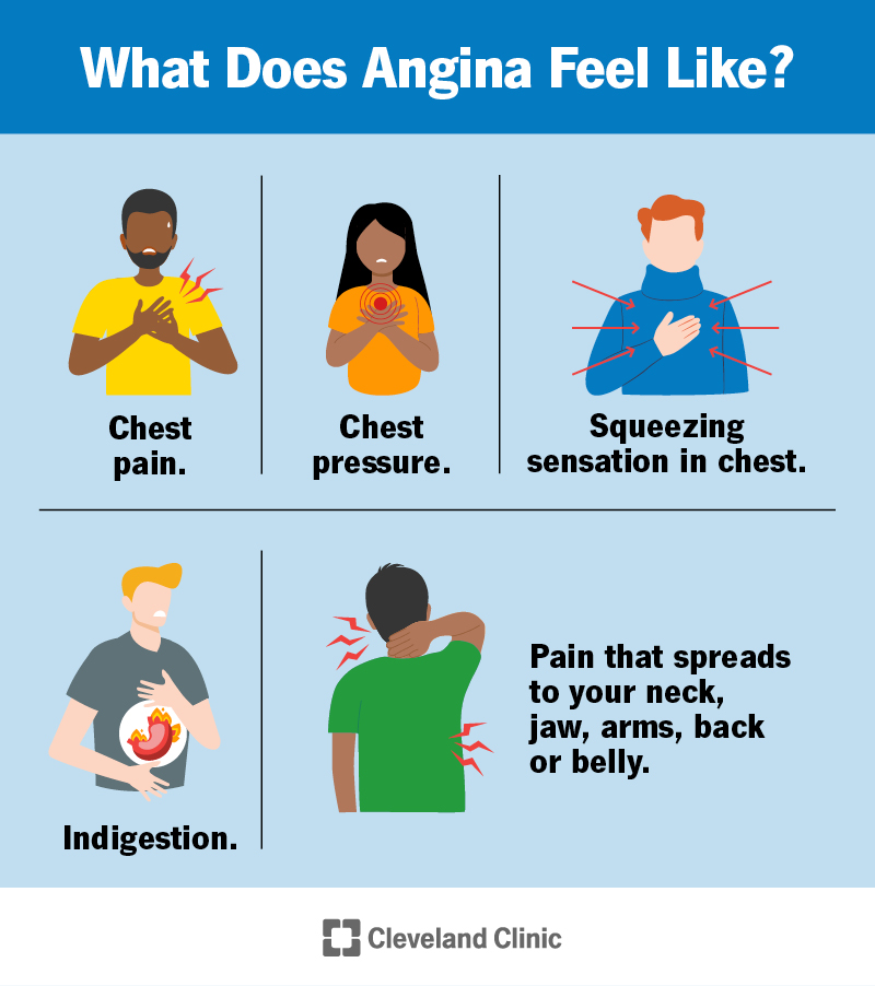 Infographic showing what angina may feel like in your chest and upper body.