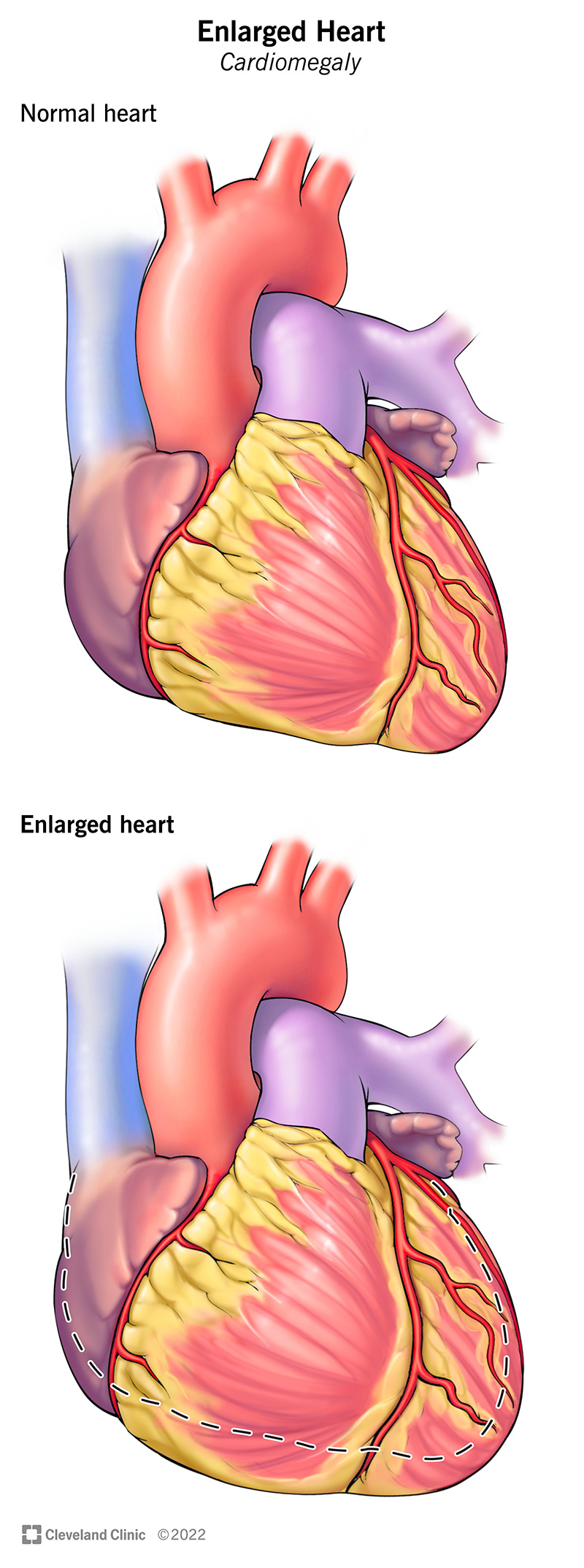 Comparing a normal heart to one with cardiomegaly.