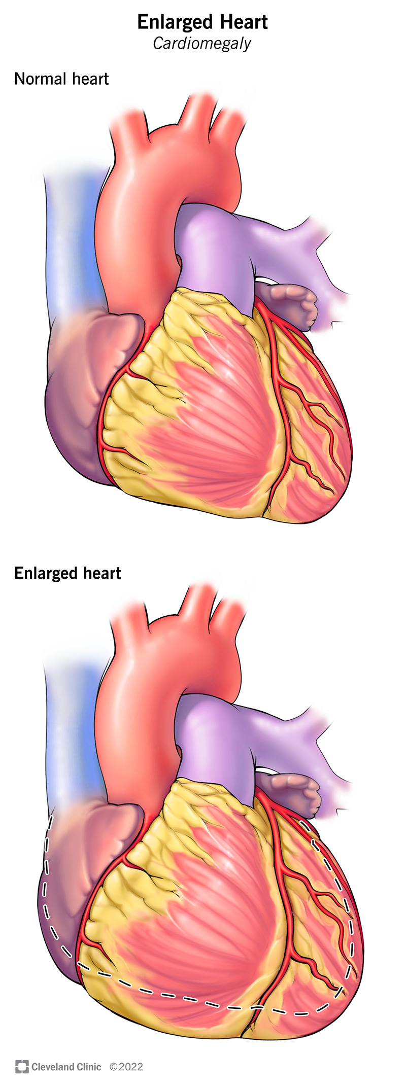 Abnormal left ventricular global strain during exercise-test in