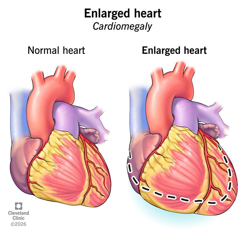 Cardiomegaly (enlarged heart) compared to a heart of typical size