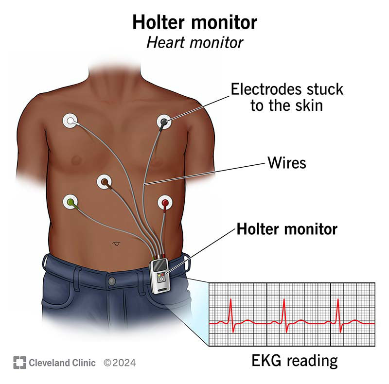 Holter monitor attached to bare chest, with electrodes and wires, showing heart rhythm